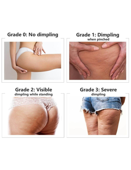 Cellulite treatment - ALIDYA