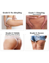 Cellulite treatment - ALIDYA