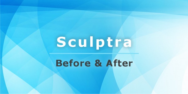 Sculptra, before and after 