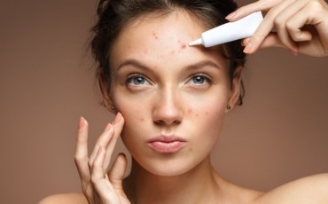 Can My Acne Scars Be Treated with Dermal Fillers?