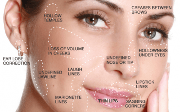 Types of  Facial Fillers