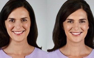 Dermal Fillers: What to Expect When They Wear Off!